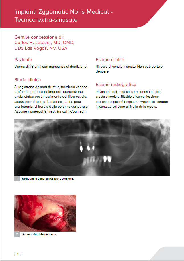 Zygomatic implants for resorbed Maxilla PDF