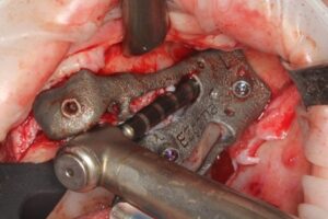 Drilling osteotomy for the Zygomatic Implant