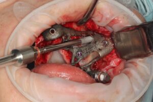 Insertion of Zygomatic implant