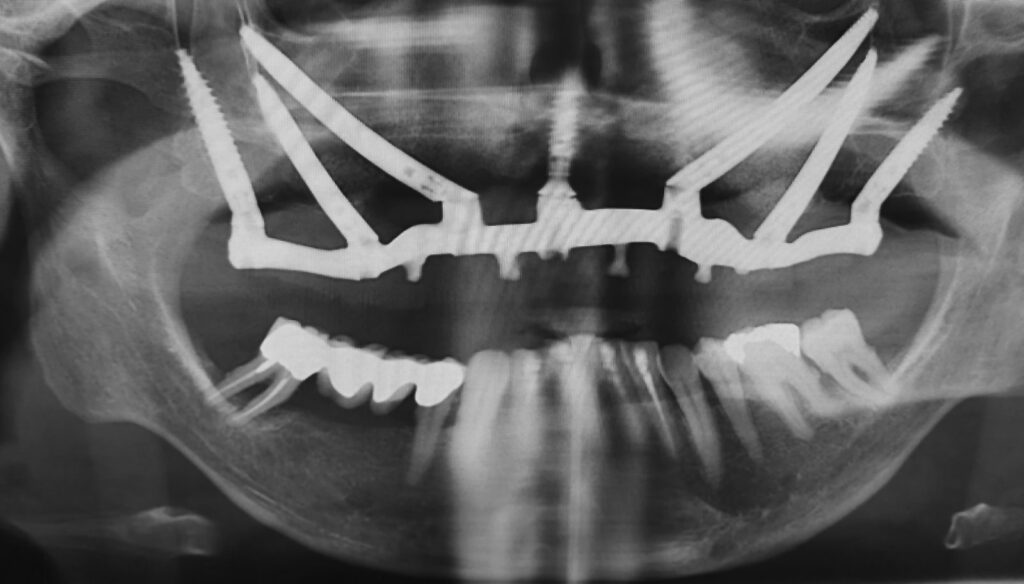 Post-operative X-Ray