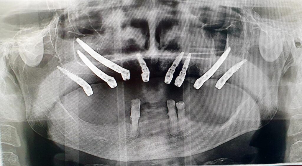 Immediate post-operative Panoramic X-Ray