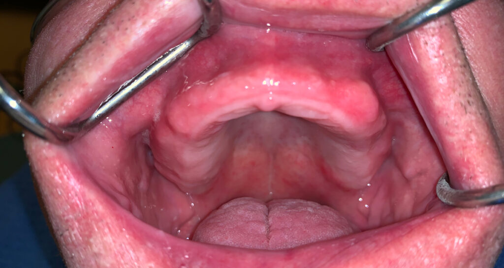 4.Intraoral condition of maxilla before surgery.