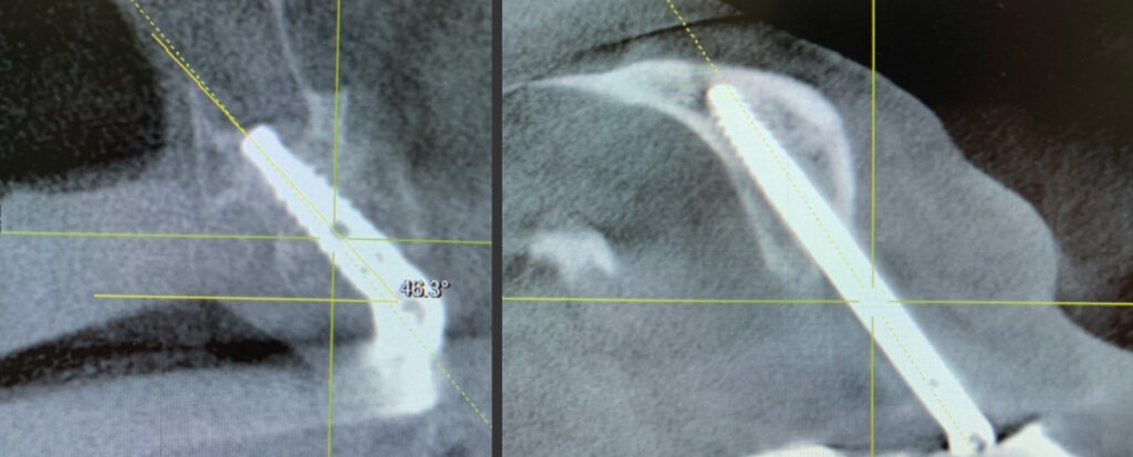 12.Lateral CBCT scan of restored case with zygomatic, pterygoid, vomer, and standard dental implants. 13. CBCT scan of Noris Medical™ Pteryfit™ implant engaging the pterygomaxillary complex.