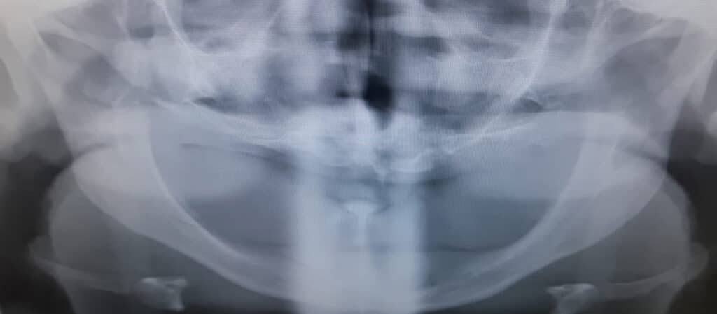 Second case Pre- operative X-ray