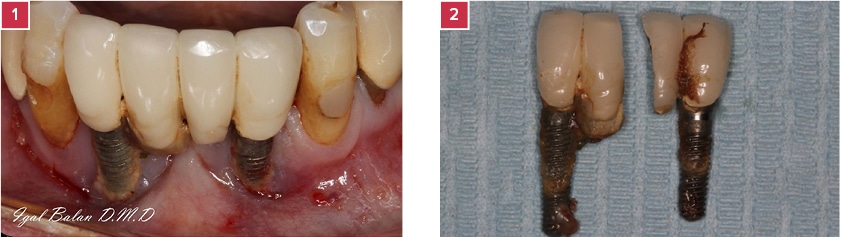 Clinical image of the lower jaw prior to the extraction. Calculus and Plaque accumulation, Implant Threads exposure, Peri-Implantitis and Mucositis are observed.